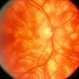 Birdshot Retinochoroidopathy